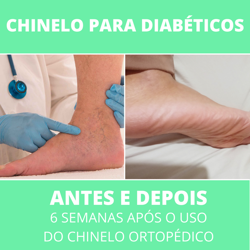 Chinelo Masculino para Diabéticos